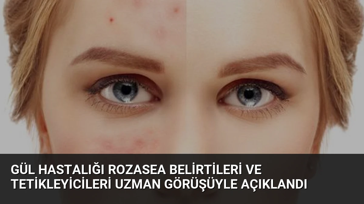 Gül Hastalığı Rozasea Belirtileri ve Tetikleyicileri Uzman Görüşüyle Açıklandı