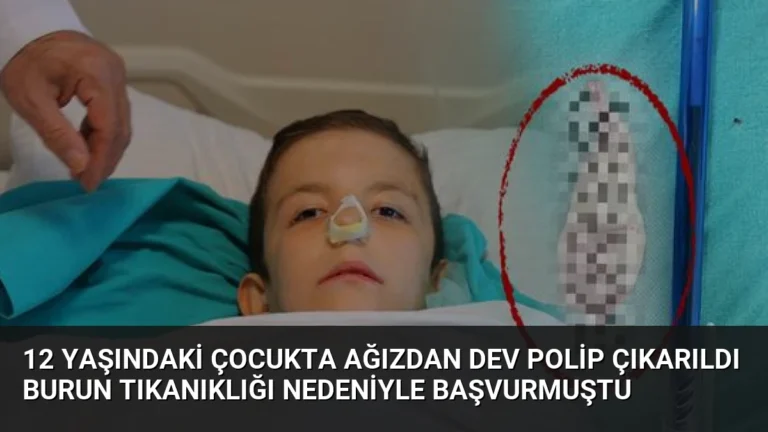 12 Yaşındaki Çocukta Ağızdan Dev Polip Çıkarıldı Burun Tıkanıklığı Nedeniyle Başvurmuştu
