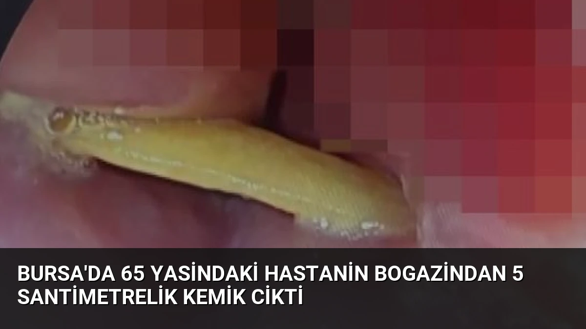 Bursa’da 65 Yasindaki Hastanin Bogazindan 5 Santimetrelik Kemik Cikti
