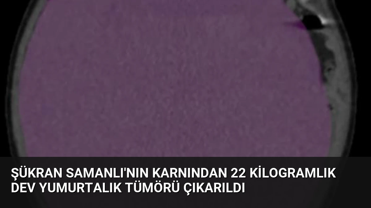 Şükran Samanlı’nın Karnından 22 Kilogramlık Dev Yumurtalık Tümörü Çıkarıldı
